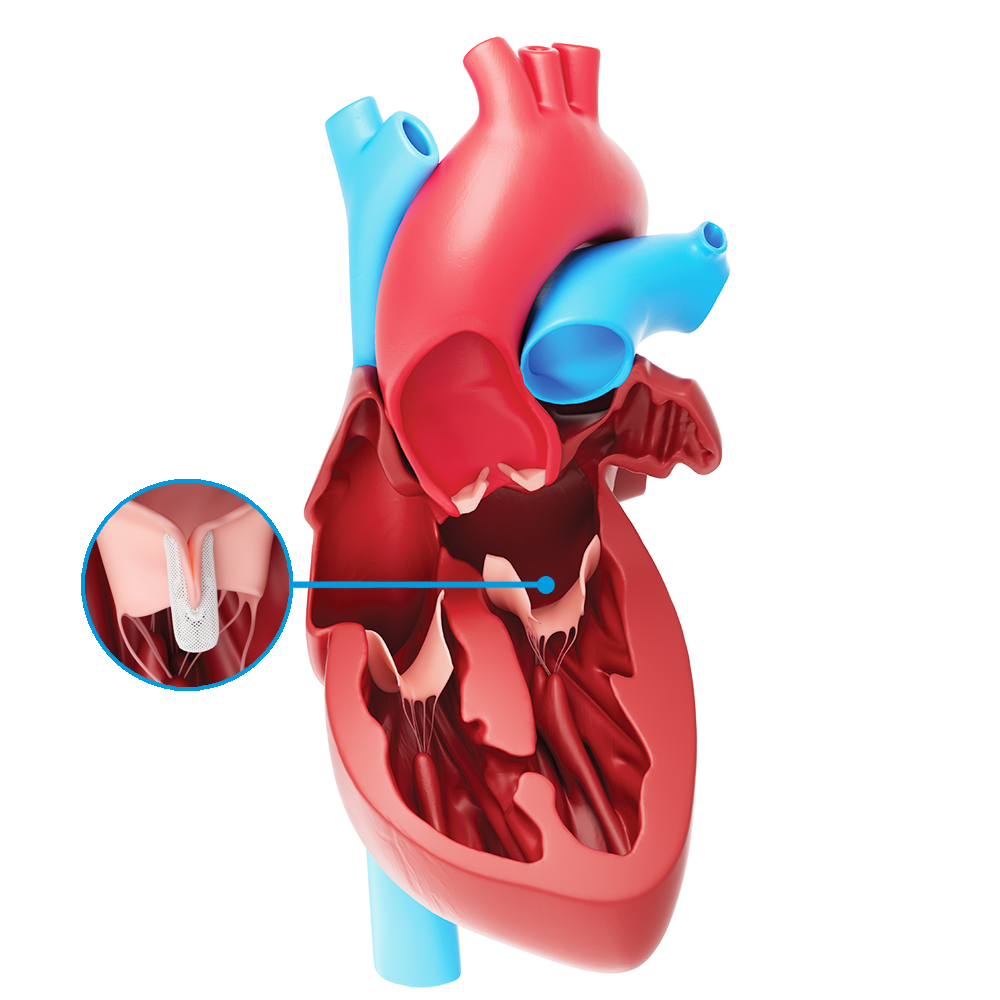 Mitral Valve Repair / Replacement (MVR) $7000-$9000