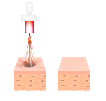 Laser Treatment for Acne Scars