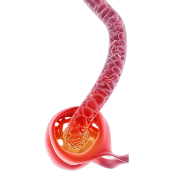 Esophageal Cancer