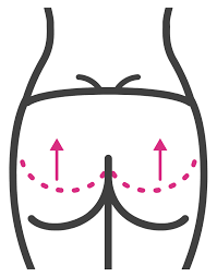 Brazilian Butt Lift