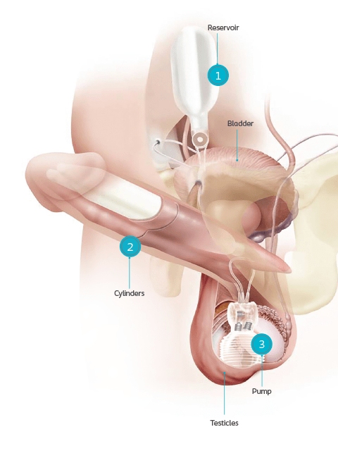 Penile implantation $4000-$7000